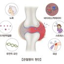 ﻿관절염 (Arthritis) 이미지