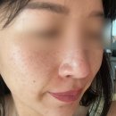 울산 달동 피지 웨딩관리 스킨뮤제 물방울 리프팅 정말 최고에요