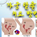 사암침, 사암침법 - 자궁 탈출증 치료 방법 - 비과학적 양의학 103 이미지