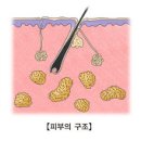 표피낭종 (Epidermal Cyst) 이미지