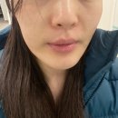 청담PC | 울산동구피부관리 에스떼청담 트라이엄 모공관리 받고 온 후기