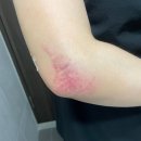 성남 다이어트 팔뚝 지방추출주사 효과 2주차 후기