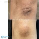 콜드플라즈마 이미지