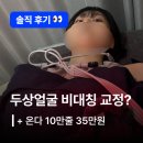 수한의원 | 안면비대칭 고칠 수 있을까? + 온다 리프팅 후기 | 오다한의원 강남점