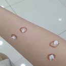 고은피부과의원 | 원주 피부과 점빼기 / 고은피부과(고은의원) 후기!!