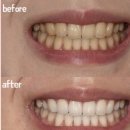 덴탈마트 | 천역 치약 맛있는 뷰티덴탈 프리미엄 레버린즈 미백치약