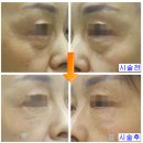 미탐화장품 | SRS레이저, 미국 특허/ FDA 승인 받을 수 있었던 이유