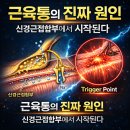 근육통은 왜 생길까? 신경근접합부와 통증유발점(Trigger Point)의 생리학적 이해 이미지