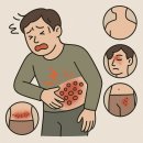 지본한의원 | 봉선동 한의원 대상포진 초기 증상과 처치법:적기 치료가 예후를 가릅니다