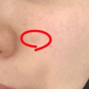 재생한의원 | 강남 흑자제거 자연재생한의원 편평사마귀 흑자제거 후기 진짜 말끔하게 사라져서 만족