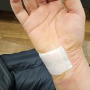 판교이엠365의원 | [판교 이엠365의원 ] *혐짤주의* 당근라페 만들다가 강판에 손바닥 베임 봉합수술 야간진료