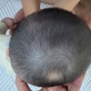 아이사랑두헬멧 대전센터 | 충주에서 대전/세종 아기 심한 단두증, 사두증 교정...헬멧 방문 추천 후기 (추천인 가능, 사례o...