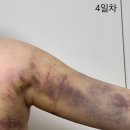 팔 - 중구 은하수로 1 | [ 팔 지방흡입 후기 내돈내산 - 4일차 ]