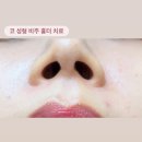 비주 | 강남 신사역 피부과 한의원 | 새살침치료 코 성형 비주 흉터 제거 후기