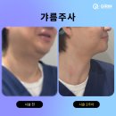 기린사우나 | 기린성형외과 지방분해주사(갸름주사) 대표원장 셀프 후기