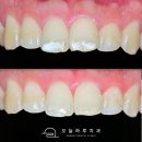 아이콘치과기공소 | 문정역치과 앞니 화이트스팟 치료, 아이콘레진으로 자연스럽게 없애는 방법