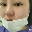 디에이치코 | 안양 성형외과 콧대주사 이브코 비포 애프터 후기
