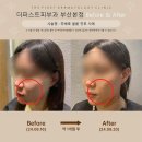 삼한사우나 | 부산쥬베룩볼륨 맞으라는 횟수 다 맞았는데 왜 효과 없죠?