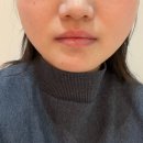 애플의원 | 홍대 쁨의원 보톡스 윤곽주사 내돈내산 당일 시술 후기