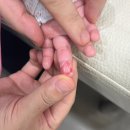 성모성형외과의원 | 바퀴에 손이 끼었어요 : 14개월 아기 마찰 화상, 심재성 2도 화상 칼로덤 성형외과 치료후기