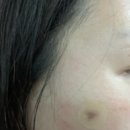 물방울성형외과의원 | 논현동 물방울성형외과 피부과 리팟레이저 흑자제거 후기