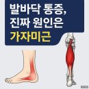 족저근막염 원인, 발바닥이 아닌 가자미근일 수 있습니다!!! 이미지