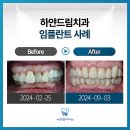 오송치과 튼튼한 임플란트 덕분에 활기찬 미소까지 되찾는 노하우