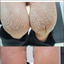 아가발케어 네이버블로그