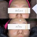 단미화장품 | [목포 에스테틱] |단미뷰티|바늘 없는 MTS시술 후기