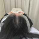 스칼프라임SMP | 천안역두피문신 스칼프라임 만족 후기