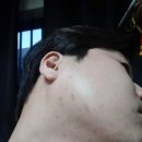 해율한의원 | 대구 여드름 치료 후기 - 해율한의원