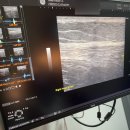 팀하트의원 | 춘천 하지정맥류 팀하트의원 방문 후기