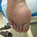 굳은살 | 용인 수지 티눈 관리 후기 - 굳은살 제거하고 한결 가벼워진 발