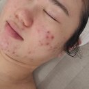 2동탄피부관리 현뷰티 스피루리나 재생케어 후기
