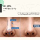 코지성형외과 네이버블로그