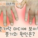 손가락 관절 통증 관절염 원인 증상 치료 예방 이미지