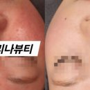 아리나뷰티케어 네이버블로그