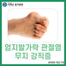 잠실역 정형외과 발가락 통증질환 무지 강직증이란 이미지