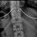 Annular fissure at L4-5 & Central Protruded herniated disc at L5-S1 이미지