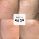 732 | 압구정 루나의원 루비레이저 한달후기 | 무려 732방 맞음(잡티는 개선, 오타모반은..)