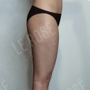 르로제의원 | 하체지방흡입 8300cc 후기 | 허리·엉덩이·무릎 라인까지 디자인, 힙입지방이식 케이스 (30대 초반)
