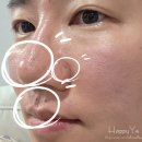 삼일한의원 | 피부결관리 홍대여드름흉터한의원 율각테라피 3차후기