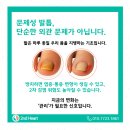 인 메드(In med) | 수원 화서역 내성발톱 교정 수술 없이 실손보험 가능한 교정기