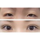 해비커뮤니케이션 | 내돈내산 강남역성형외과 눈재수술 쌍수후기(+2달차)