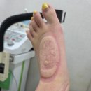 중로1-233,중로1-234 | 45Days~49Days(클라이밍 지구력 추락 사고 중족골 234번 발등 골절)_마지막 재택 일기_드디어 목발 일상...