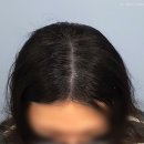 수원-2030 | 수원 2030 여자 가르마 정수리 두피문신 과정 후기