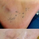 나세르의원 | [강남 문신제거 후기] 나세르 의원