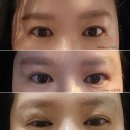 멍이방앗간 | 청담 아이업 눈꺼풀실리프팅 생생 후기 - 비포&amp;애프터 포함