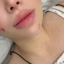 위시티로 | [경기/고양시] 위시티 아이브(IVE) 입술 오버립 내돈내산 후기💋 자연스럽게 볼륨감 UP!