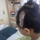 10살남아 2차수술 잘 마치고 퇴원햇습니다 이미지